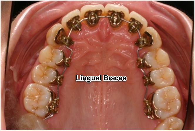 Lingual Braces